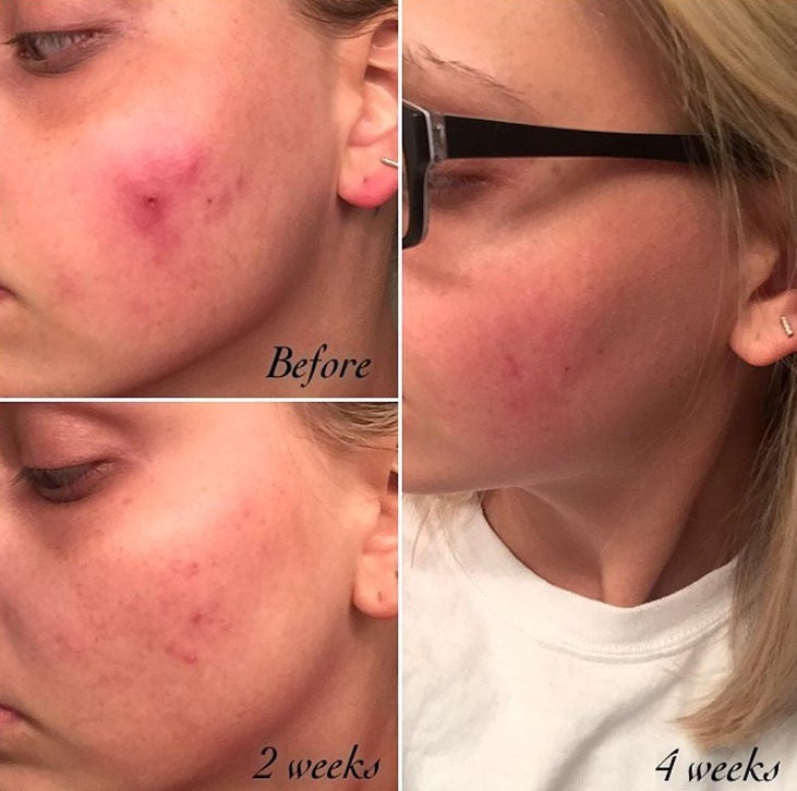 3-Step Acne System – Consulate X, view 7 of 11