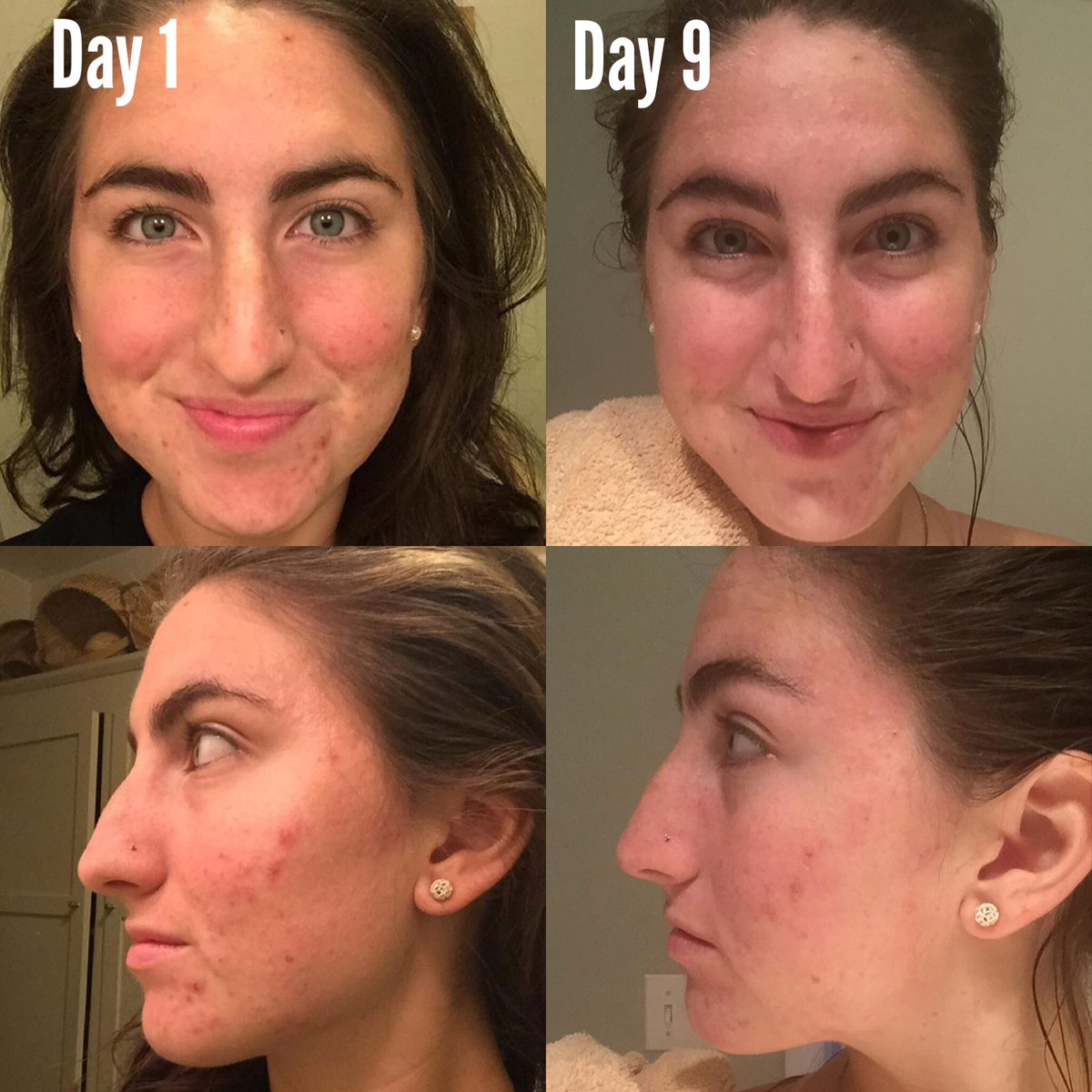 3-Step Acne System – Consulate X, view 6 of 11