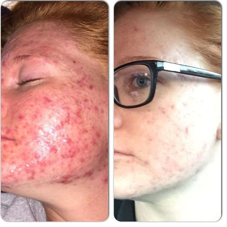 3-Step Acne System – Consulate X, view 10 of 11