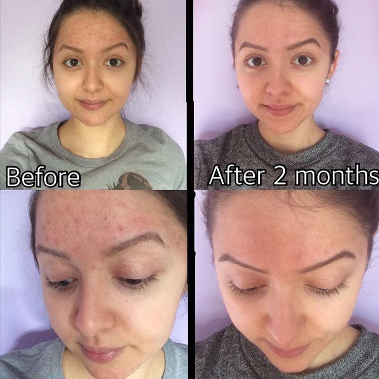 3-Step Acne System – Consulate X, view 5 of 11