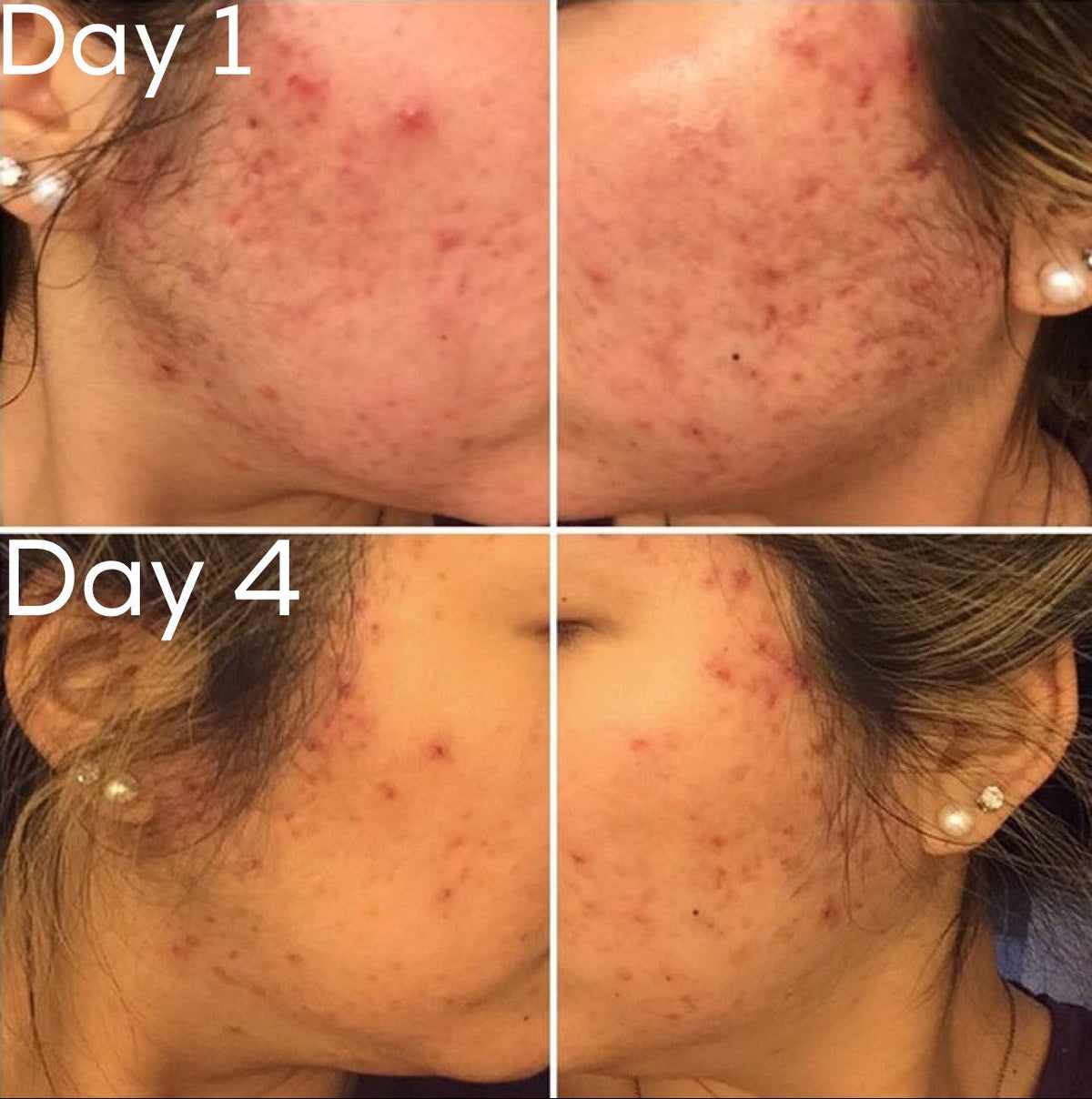 3-Step Acne System – Consulate X, view 8 of 11