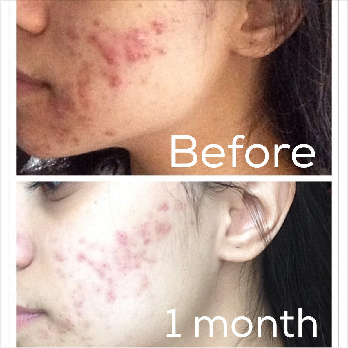 3-Step Acne System – Consulate X, view 9 of 11